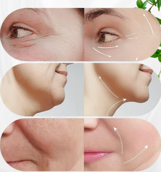 Recontura™ | Zichtbaar strakkere kaaklijn zonder salonbezoek