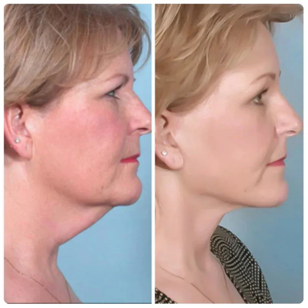 Recontura™ | Zichtbaar strakkere kaaklijn zonder salonbezoek