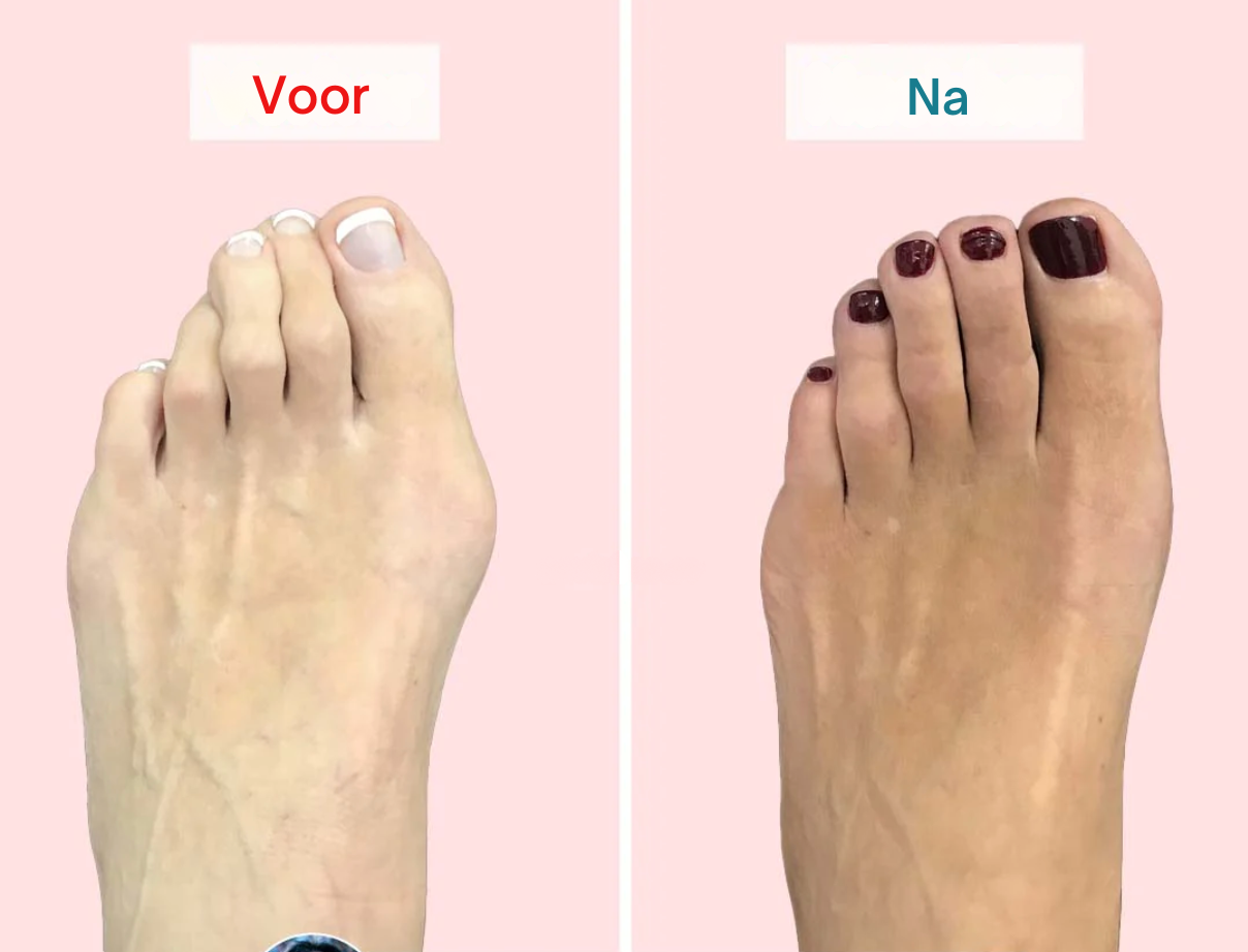PerfectToes - Natuurlijke teen scheider