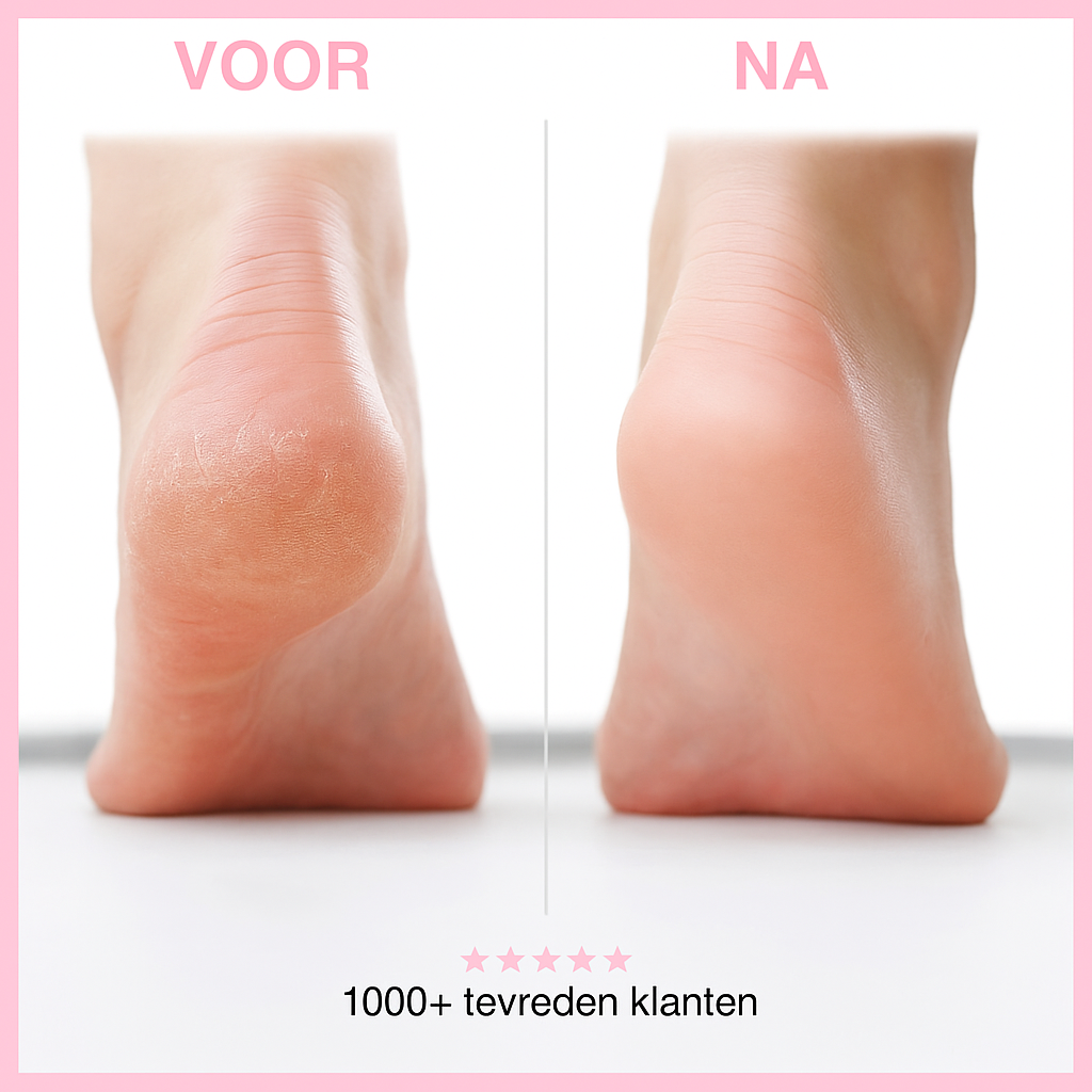HeelEase™ | Elektrische eeltverwijderaar