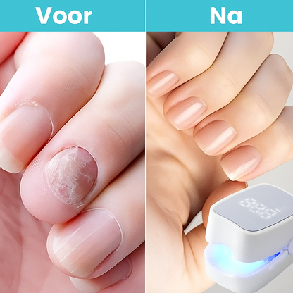 Dermalight™ | Zichtbaar gezonde nagels zonder gedoe – gewoon bij je thuis