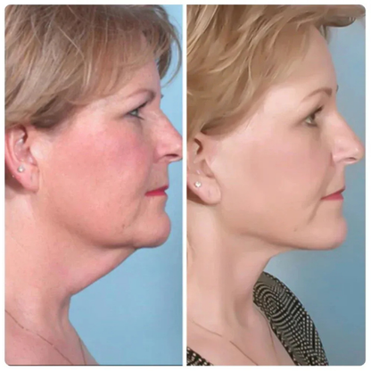 Recontura™ | Zichtbaar strakkere kaaklijn zonder salonbezoek